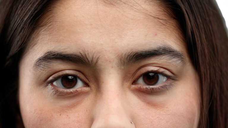 What Causes Dark Circles Under the Eyes