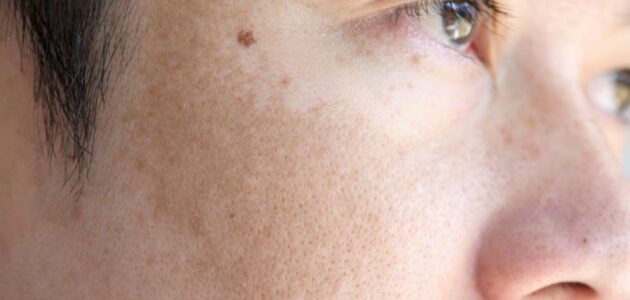 melasma