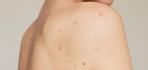 How to Treat and Prevent Back Acne