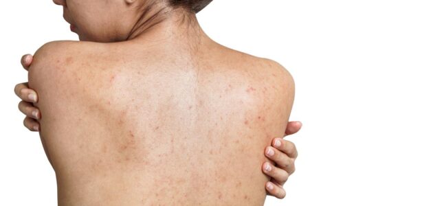 Understanding the Causes of Back Acne