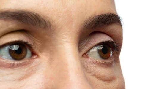 How HIFU Reduces Eye Bags and Lifts the Under-Eye Area
