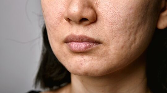 Juvelook for Acne Scars & Pores