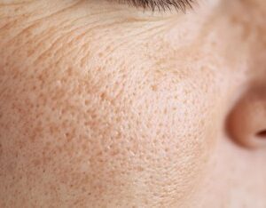 Pores