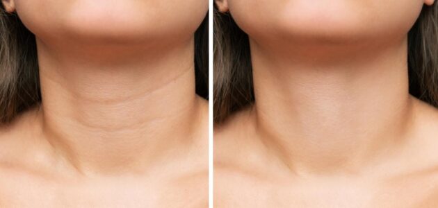 Why Your Neck Ages Faster Than Your Face: Stages & Treatments