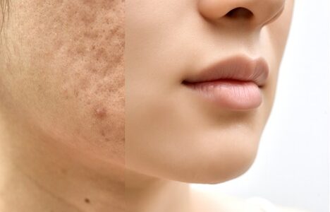 Home Remedies for Acne Scar Treatments