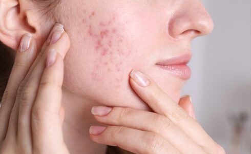 Why Some Acne Scars Never Fade