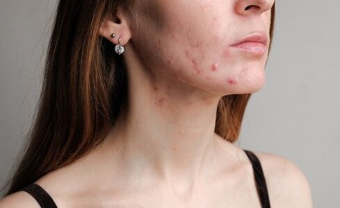 Acne Scar Prevention