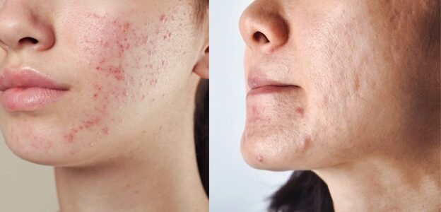 Acne Marks vs Acne Scars: What’s the Real Difference?