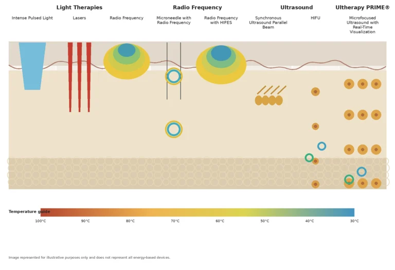 Ultherapy PRIME micro-focused ultrasound energy depth diagram