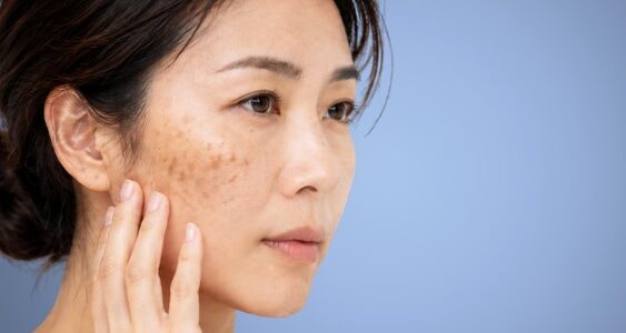 Woman with cheek pigmentation comparing Pico Ultimate Laser and Pro Yellow Laser at Luna Clinic KL