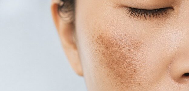 Close-up of cheek melasma pigmentation before treatment at Luna Clinic KL